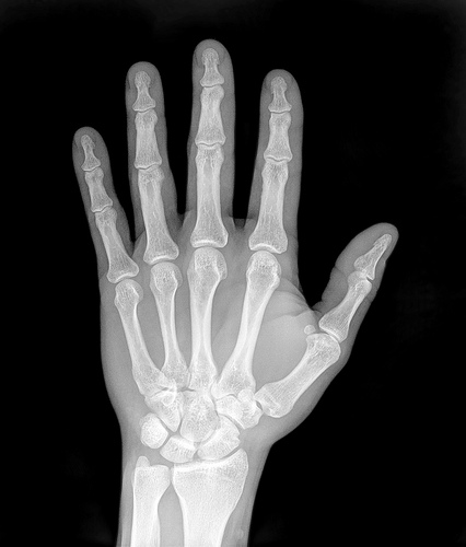 Hand X-Ray by Trace Meek, on Flickr